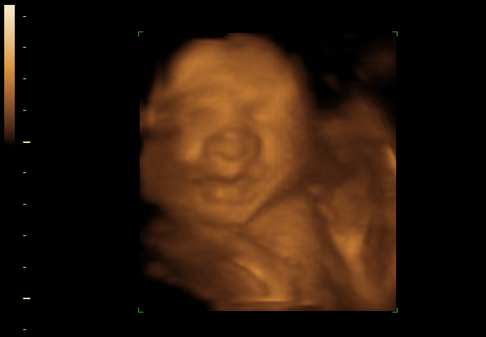 3D ultrasound image at 27 weeks